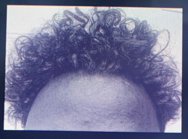 a cyanotype image of a forehead and scalp cwith curly hair 